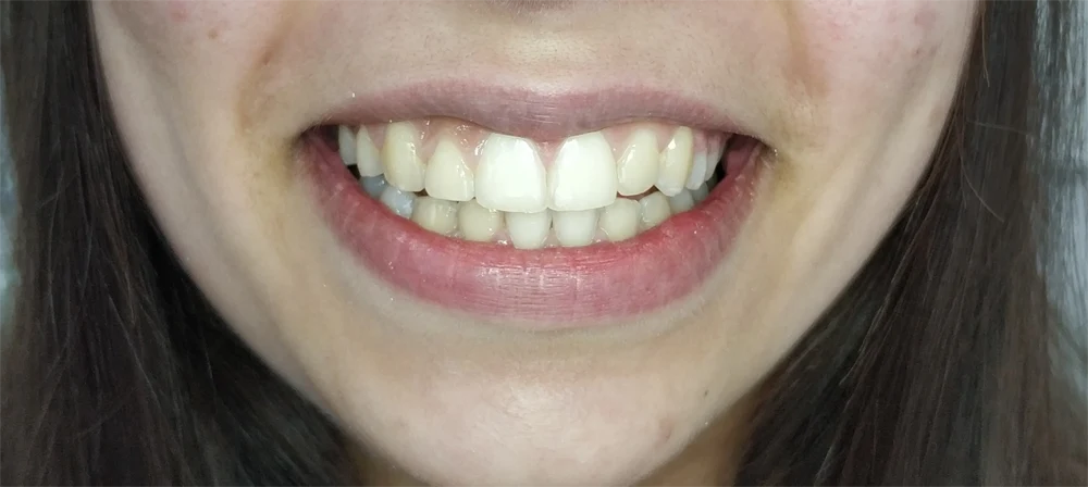 Caso 4 Depois de Correção de Ortodontia Invisível