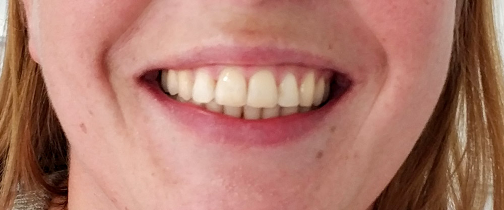 ortodontia-final-dentista-aveiro