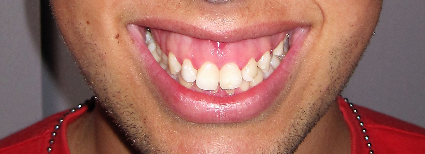 ortodontia inicial